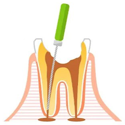 「リーマー」という器具を 使い汚染された歯の神経を 取ります。